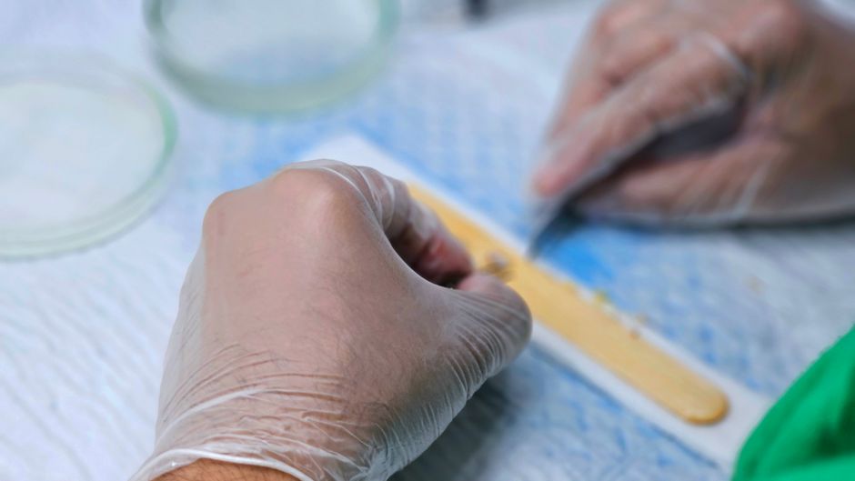 Detailed view of hair graft preparation during a hair transplant surgery.